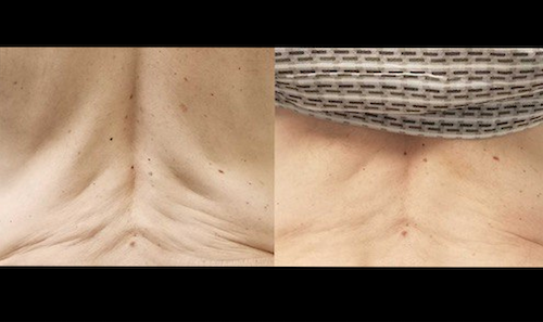 Skin Tightening Facial Tightening Mississauga Oakville